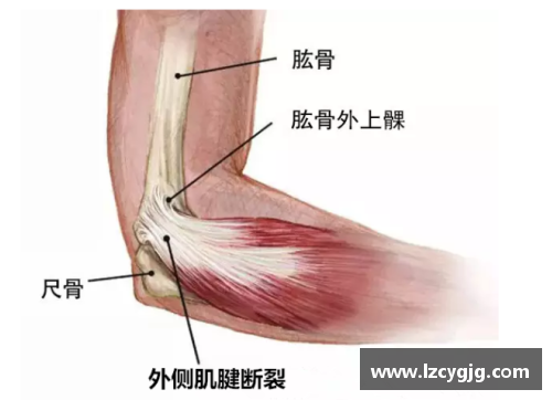 体育明星跟腱二次断裂事件揭示运动损伤严重性与恢复难度